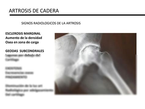 SOLUTION: Artrosis de cadera - Studypool