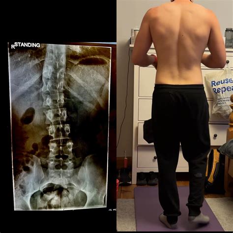 Is this fixable cobb angle is around 13 degrees S shape scoliosis : r/scoliosis