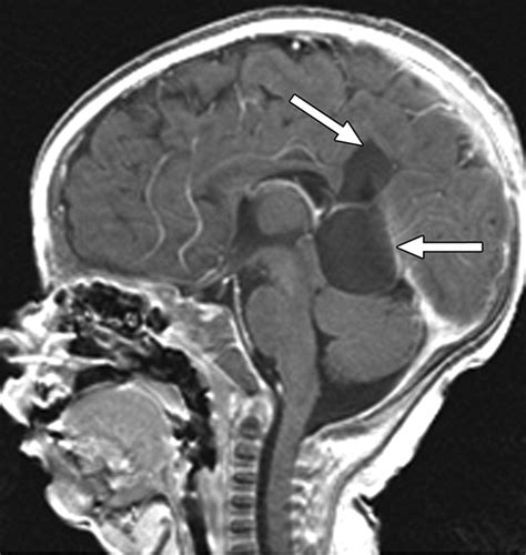 Choroid Plexus Cyst Ultrasound