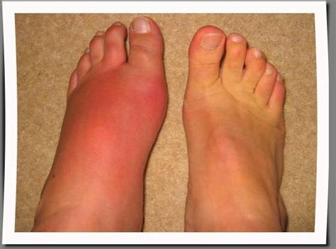 Causes of Unexplained Swelling of Left Foot and Ankle | IYTmed.com