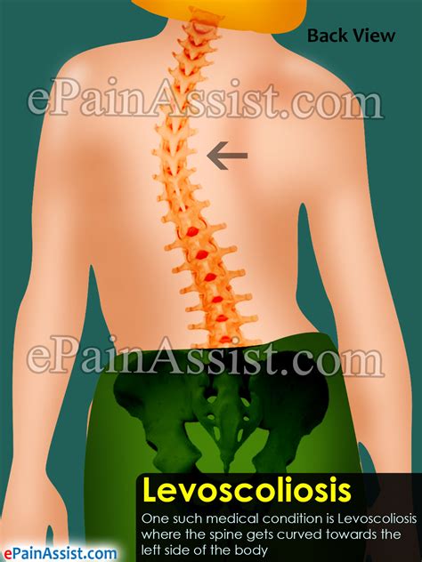 levoscoliosis of the lumbar spine - Captions Watch