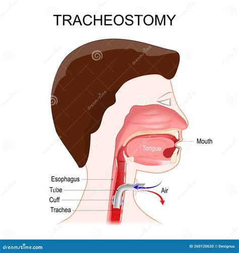 Tracheostomy Tube Placement