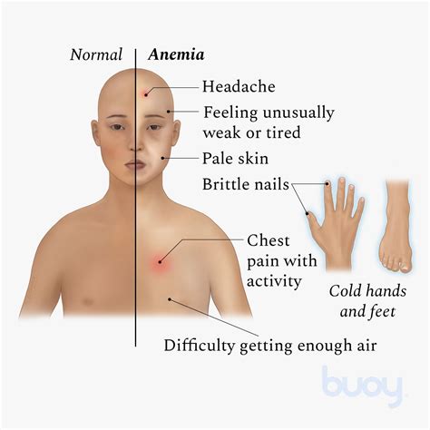 Anemic Skin Rash