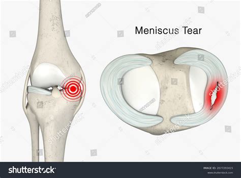Meniscus Tear 3d Rendering Knee Anatomy 库存插图 2077293415 | Shutterstock