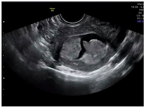 Learning Curve for Ultrasound Assessment of Myometrial Infiltration in Endometrial Cancer ...