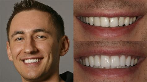 Porcelain Veneers For Missing Teeth at John Pavon blog