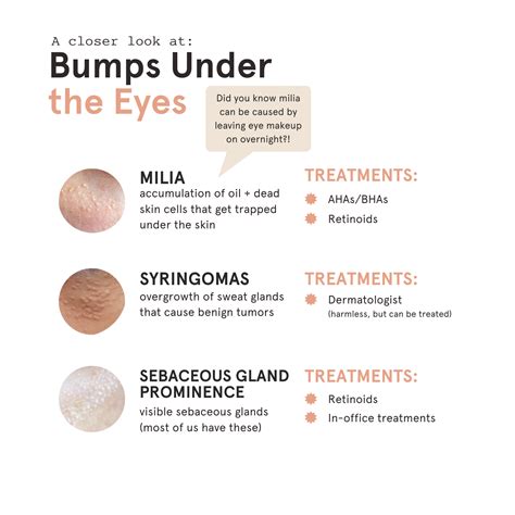Bumps under eyes, Sebaceous gland, Skin care