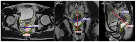 Surgical Staplers in Laparoscopic Colectomy: A New Innovative Flexible ...