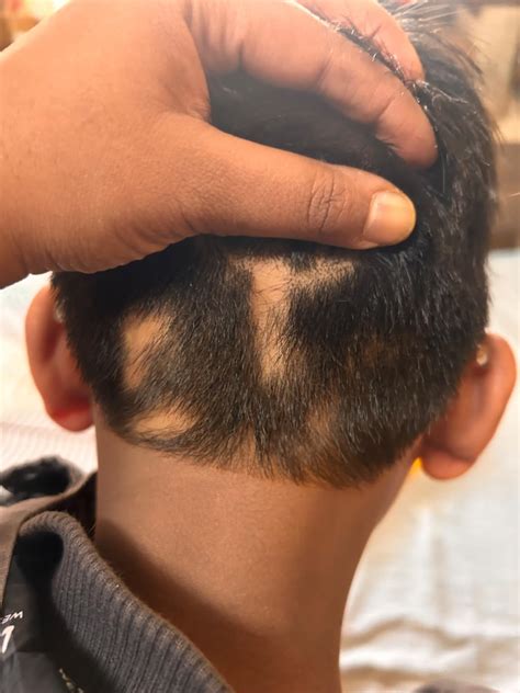 Buy Aratacure - Alopecia Areata Spray 100ml | Hair Fall Control for ...