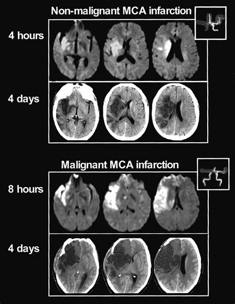 Middle Cerebral Artery Mri