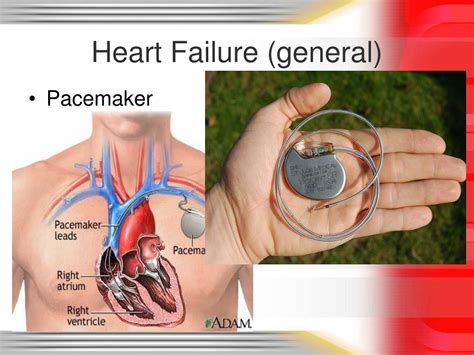 Image result for Heart Failer Compensatory Processes