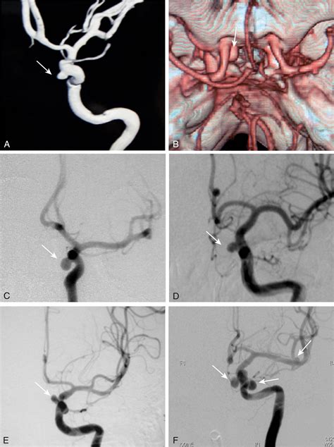 Surgical Treatment of Paraclinoid Aneurysms - Clinical Tree