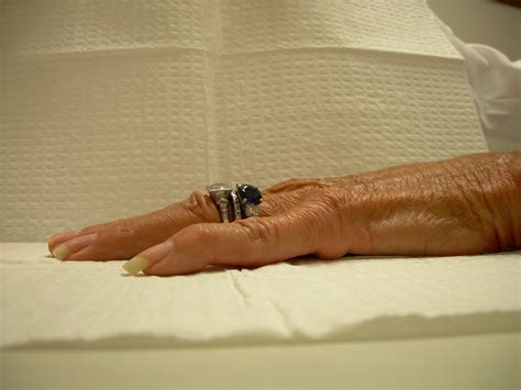 Image result for Hand Dysfunction