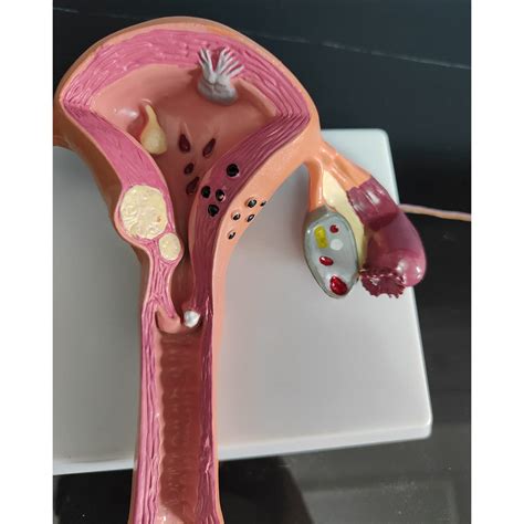 SIULAS Pathological Uterus Model - Life Size Human Uterus India | Ubuy
