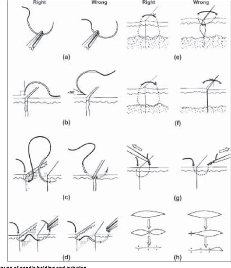 Image result for Common Suture Patterns