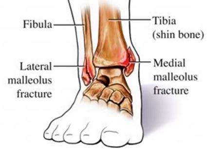 Medial Malleolus Fracture - Treatment, Symptoms, ICD 10, Causes, What