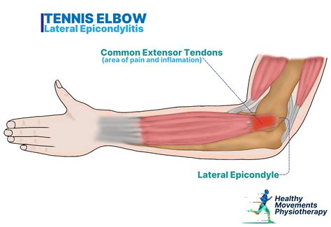 Dry Needling and Tennis Elbow: Does It Really Work - Healthy Movements Physiotherapy