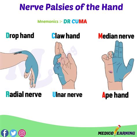 Nerve Palsies of Hand Mnemonic – MedicoLearning
