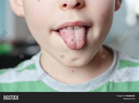 White Spots On Tongue Image & Photo (Free Trial) | Bigstock
