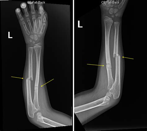 Radius Fracture 的图像结果