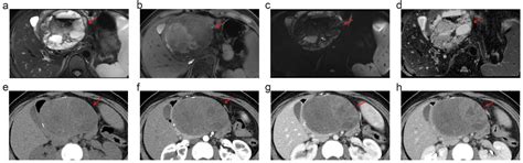 Clinical Feasibility of 5.0 T MRI/MRCP in Characterizing Pancreatic ...
