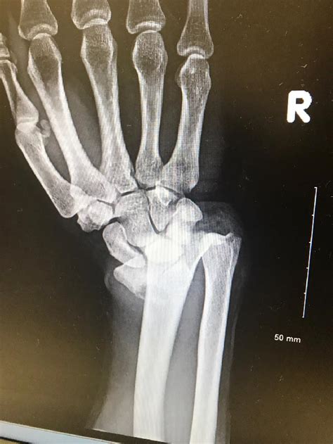 Image result for Distal Radius Fracture Recovery