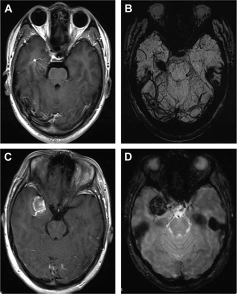 Developmental Venous Anomalies - Neurosurgery Clinics