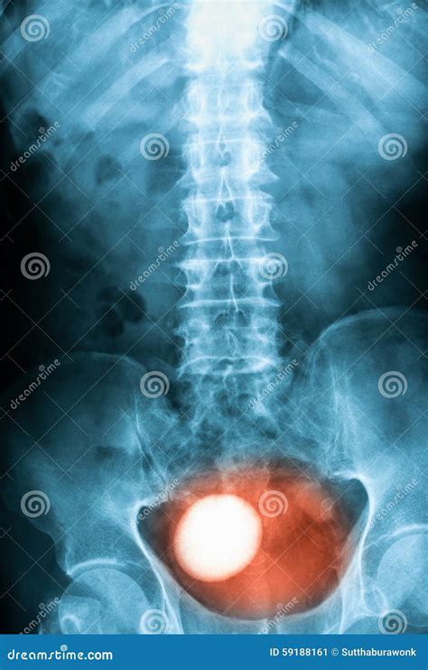 X-ray Image of Plan KUB(Kidney,Ureter and Bladder), Supine View Stock ...