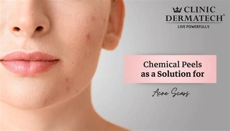 5 best chemical peels for acne scars | best chemical peel for acne scars | XAKY