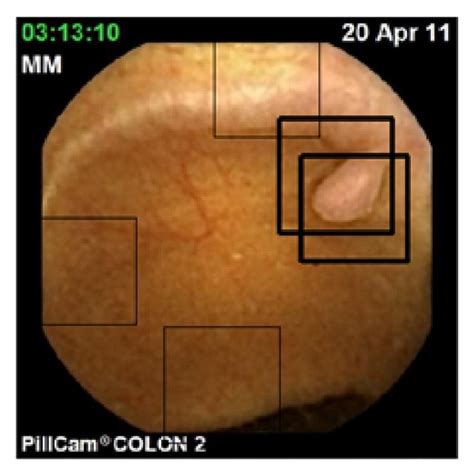 Image result for Polyp Detection Device