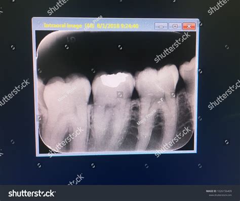 Normal Wisdom Teeth X Ray When Do Wisdom Teeth Come In? Signs,