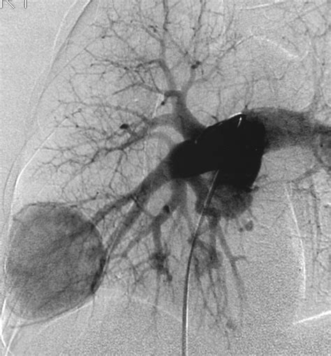 Pulmonary Arteriovenous Malformations: Effect of Embolization on Right-to-Left Shunt, Hypoxemia ...