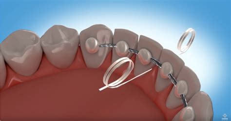Image result for Using a Floss Threader