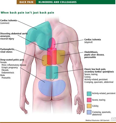 Back Pain Causing Pain In Ribs at Jason Seman blog