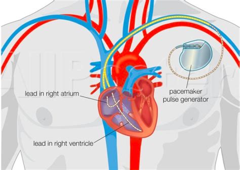 Pacemaker Procedure 的图像结果