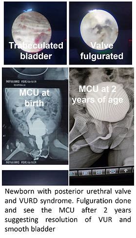 Posterior Urethral valve | pediatricsurgery.in