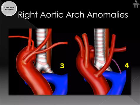 Aortic arch anomalies | PDF