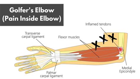 Golfers Elbow Inner Elbow Pain (A Helpful Guide For Lifters)