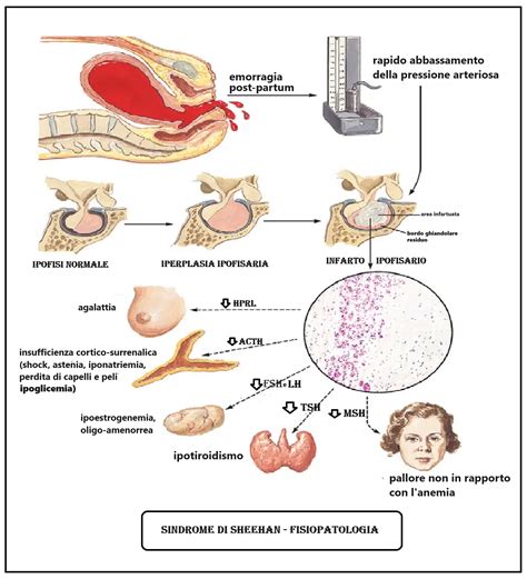 Sindrome di Sheehan – FertilityCenter