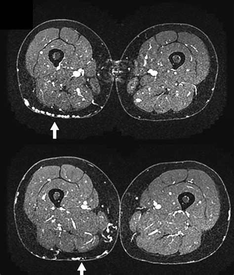 Pelvic Venous Insufficiency: Imaging Diagnosis, Treatment Approaches ...
