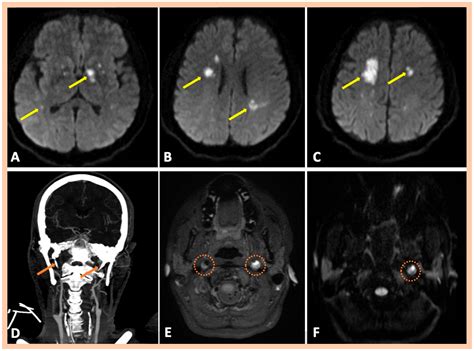 Spontaneous Multiple Cervical Artery Dissections Detected with High ...