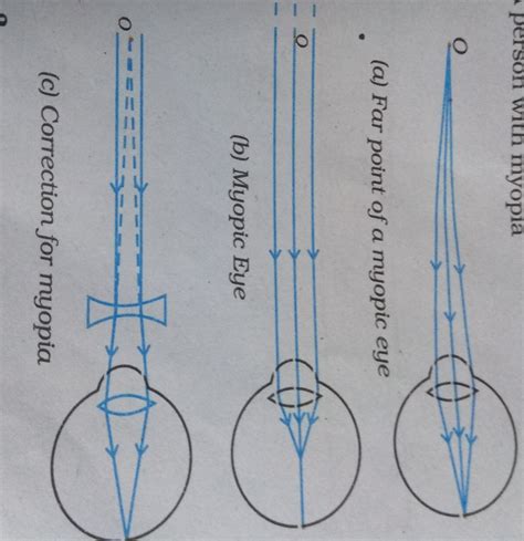 What is short sightedness ? State the two causes of short-sightedness ...