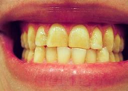 Image result for SE Brosser Les Dents