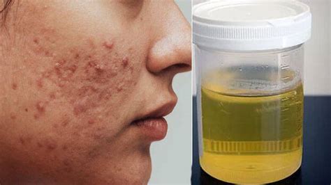 Sounds unbelievable but true people use own urine to get rid of pimples ...