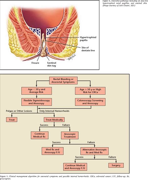 List 92+ Pictures Before And After Hemorrhoid Surgery Pictures Updated