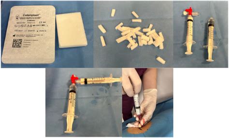 Use of Injection of Hemostatic Gelfoam Mixture During Percutaneous Core ...