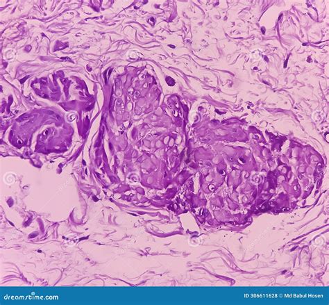 Prostatic Chips (TURP): Adenocarcinoma. it Reveals an Infiltrating Adenocarcinoma. Prostate ...
