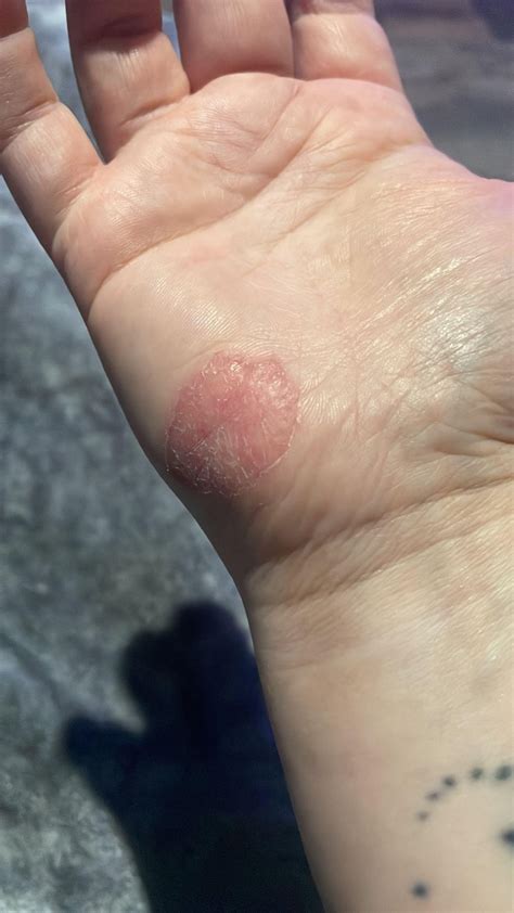 Growing patch of dry/sore skin on palm of hand 🖐 : r/DermatologyQuestions