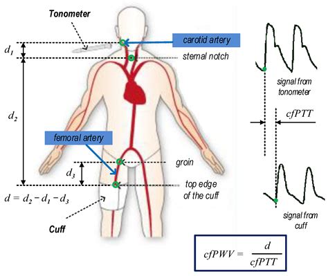 Femoral Pulse Landmark