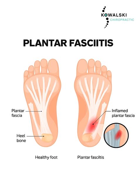 Kowalski Chiropractic | Understanding Plantar Fasciitis: Causes, Symptoms, and Treatment Options ...